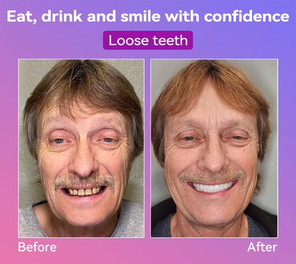 Vioralifes® Next-Generation Comfort Dentures (Luxurious dentures, lightweight and easy to wear — limited-time 70% OFF)